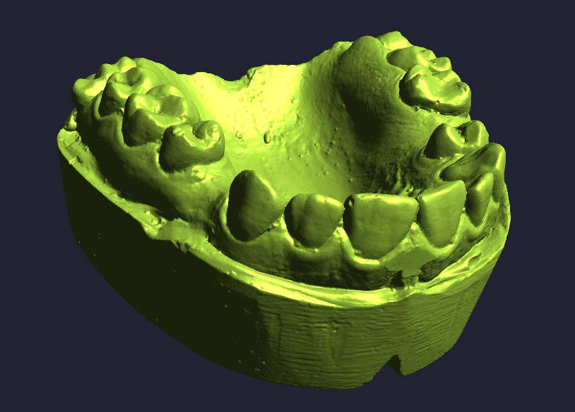 Plaster dental impression